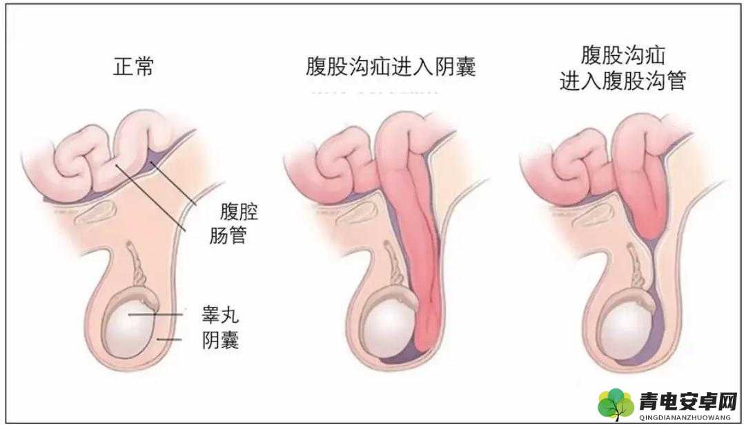 我们班那个男生睾丸特别大引发的相关思考